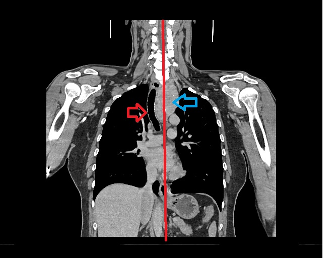 CT scan For Retrosternal