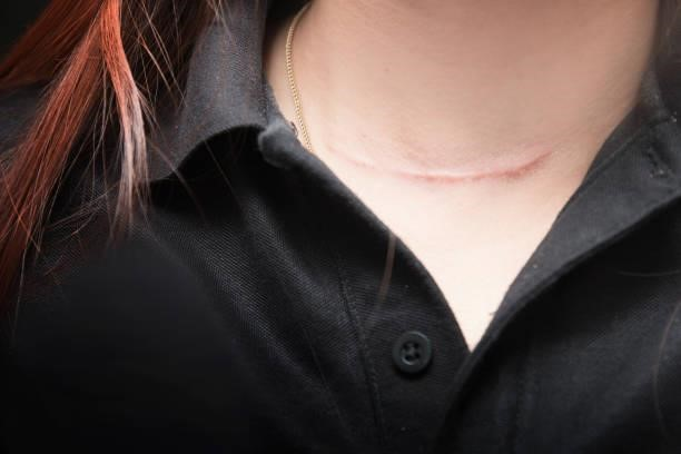 Thyroid Surgery Scar