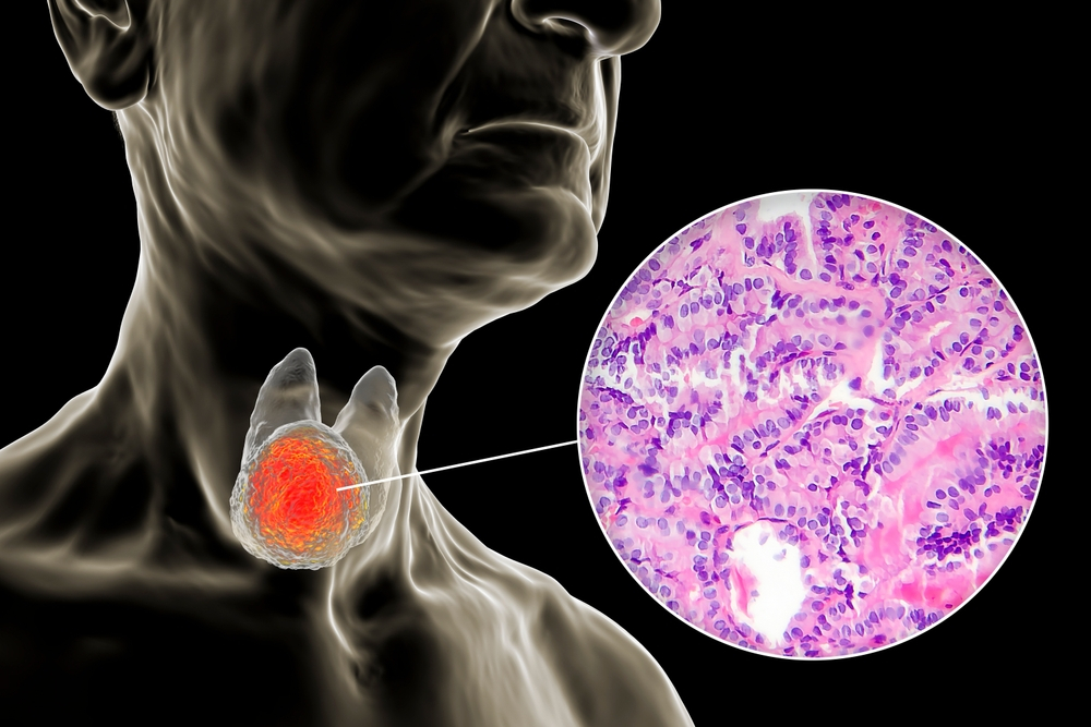 Follicular thyroid cancer