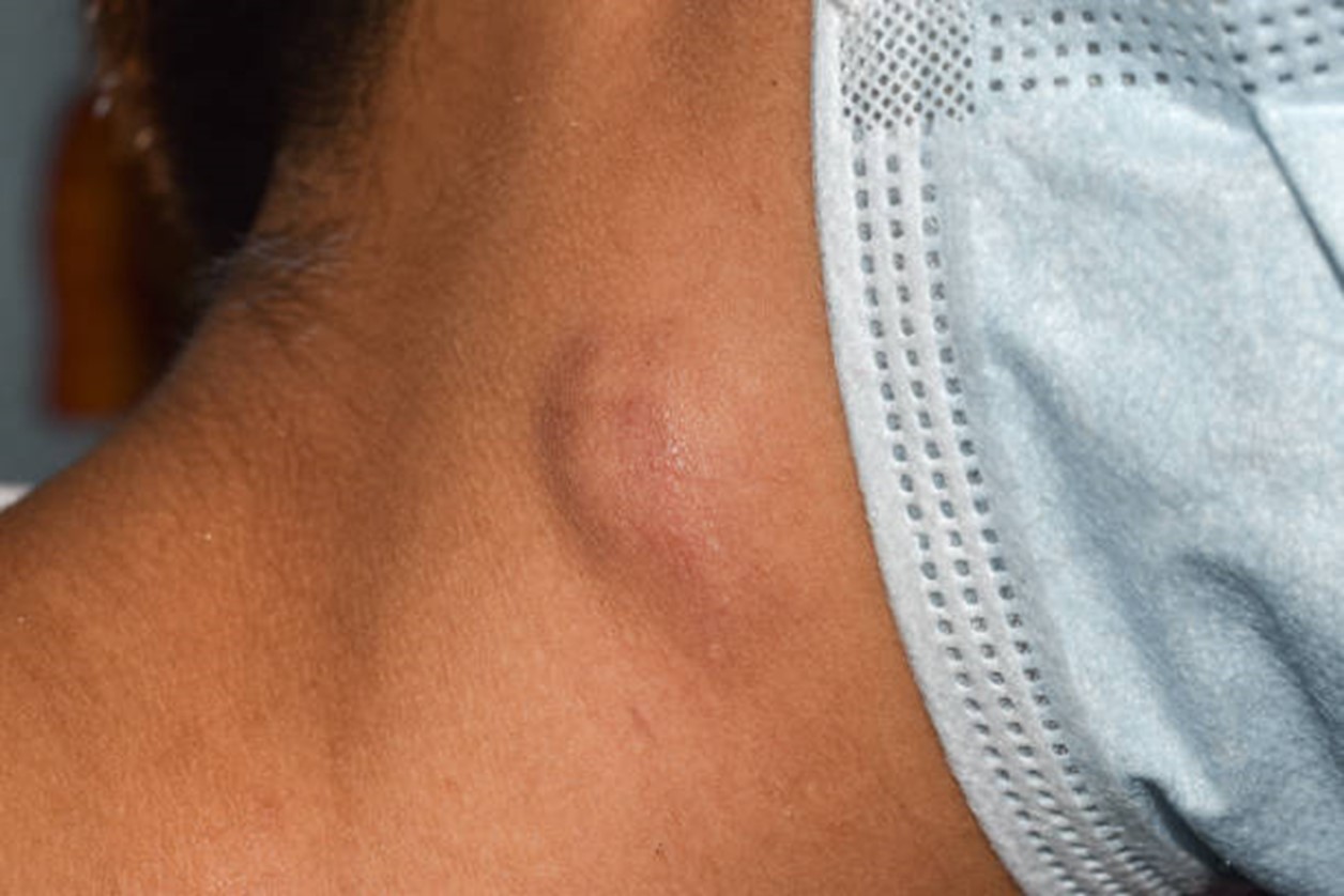 enlarged lymph nodes