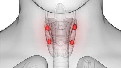 parathyroid cance