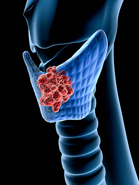 Combined Thyroidectomy