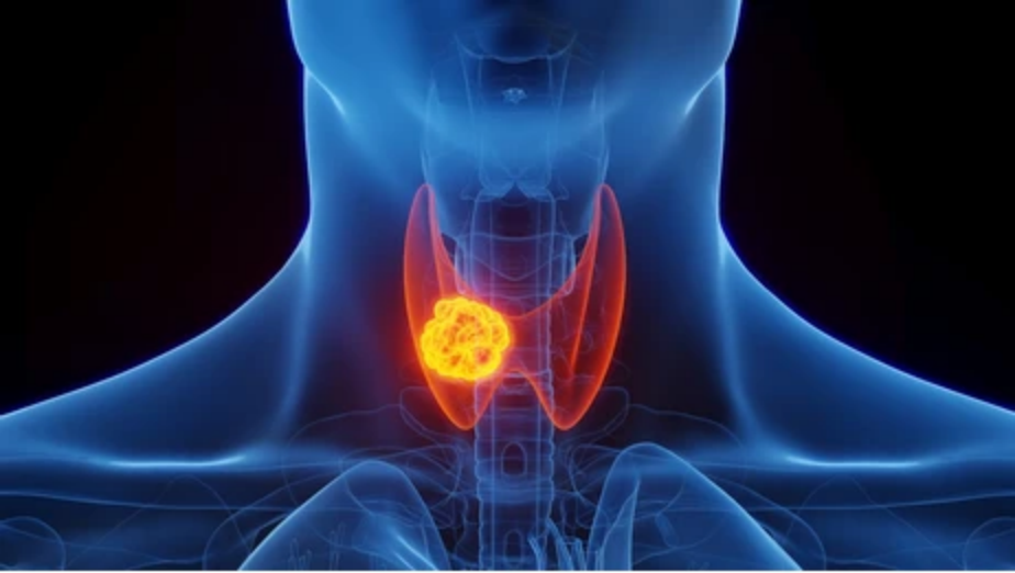 What is Papillary Thyroid Carcinoma (PTC)?