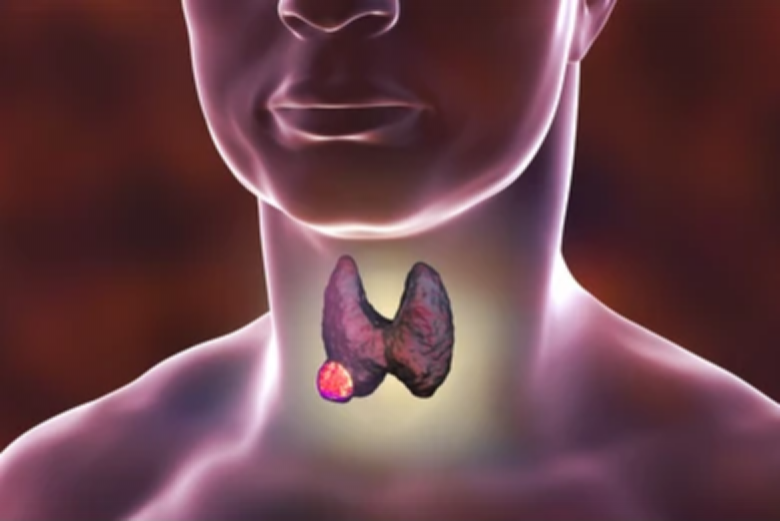 What Is Low-Risk Papillary Thyroid Cancer?