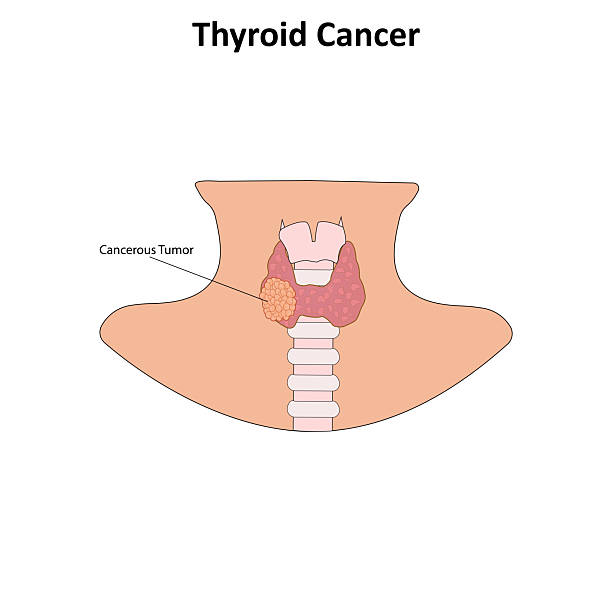 Hurthle Cell Carcinoma
