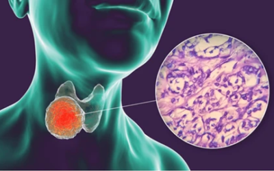 Follicular Adenoma Vs Carcinoma