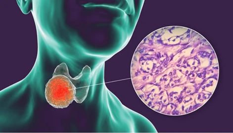 Follicular Adenoma Vs Carcinoma