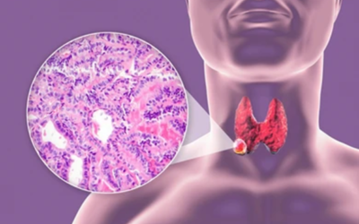 Understanding Low-Risk Papillary Thyroid Cancer