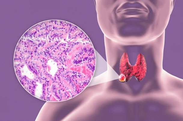 Understanding Low-Risk Papillary Thyroid Cancer