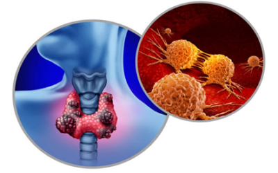 Papillary vs. Medullary Thyroid Cancer
