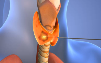 Toxic (Hot) Thyroid Nodules: Causes, Symptoms, Diagnosis & Treatment