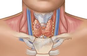 Can Anaplastic Thyroid Cancer Be Cured-Dr Sandeep Nayak