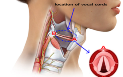 Will My Voice Change After RABIT Surgery?