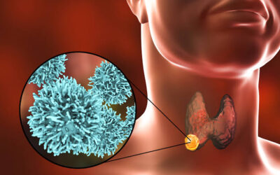 What Is Medullary Thyroid Cancer?