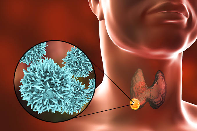 What Is Medullary Thyroid Cancer?