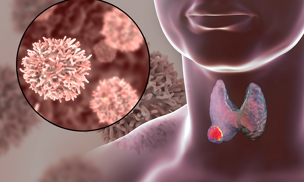 Thyroid Nodules More Likely to Be Cancer