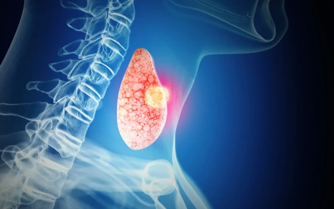 Which Thyroid Nodule Is More Likely to Be Cancer